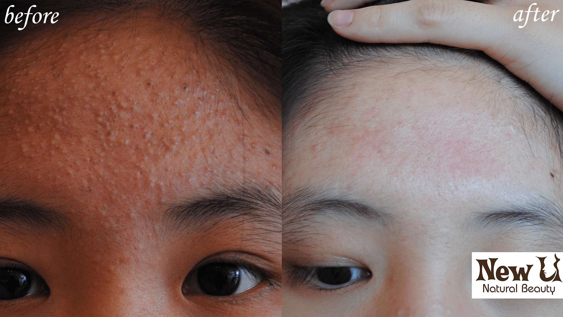 Acne Treatment Scar Removal Las Vegas Before and After