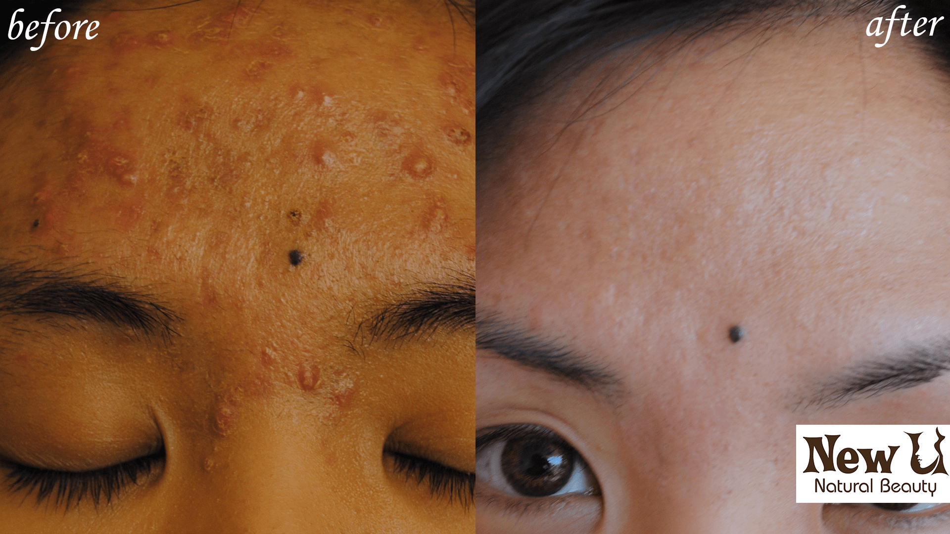 Acne Treatment Scar Removal Services Las Vegas Before and After