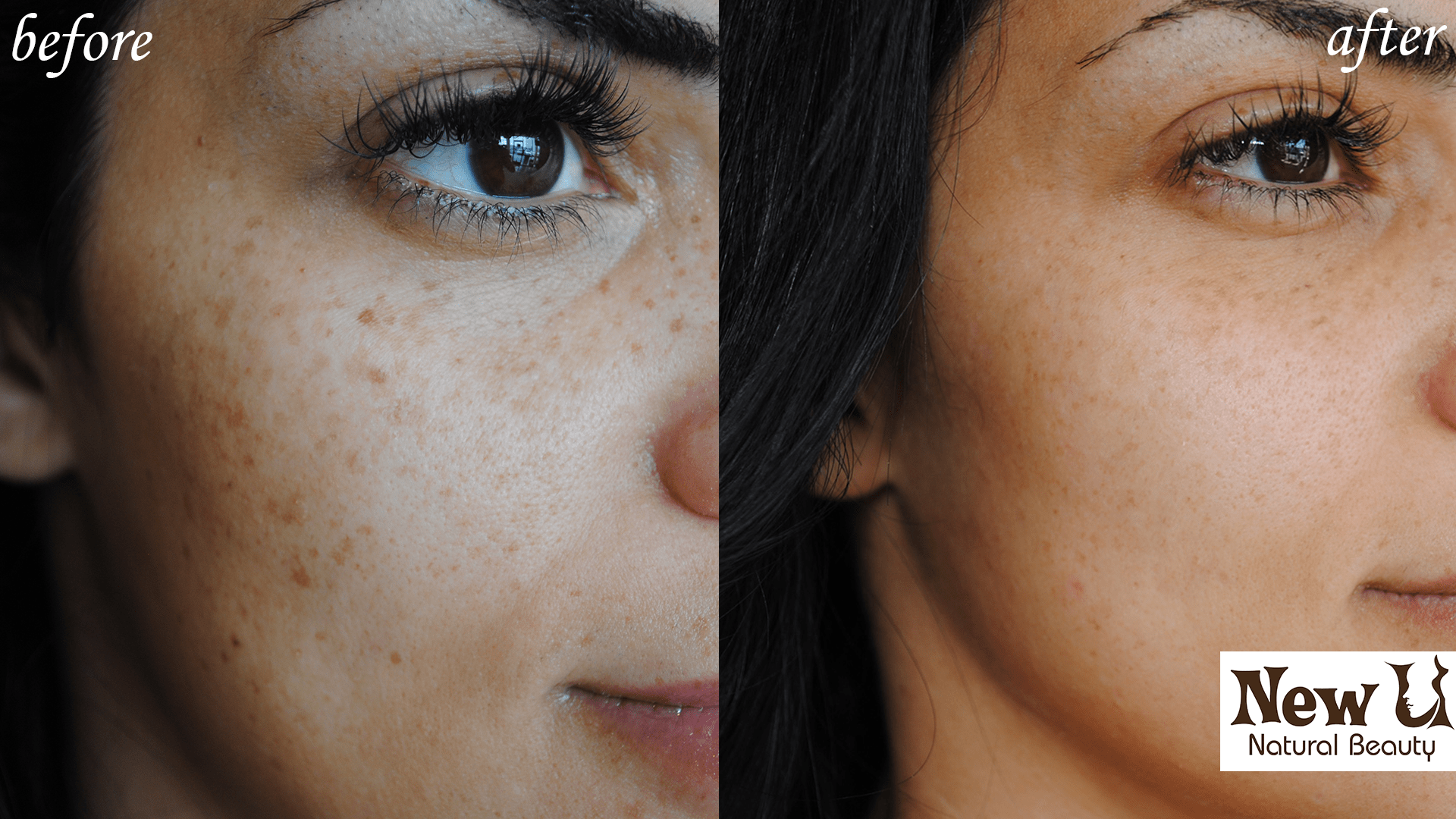 Skin Pigmentation 3 Las Vegas Before & After