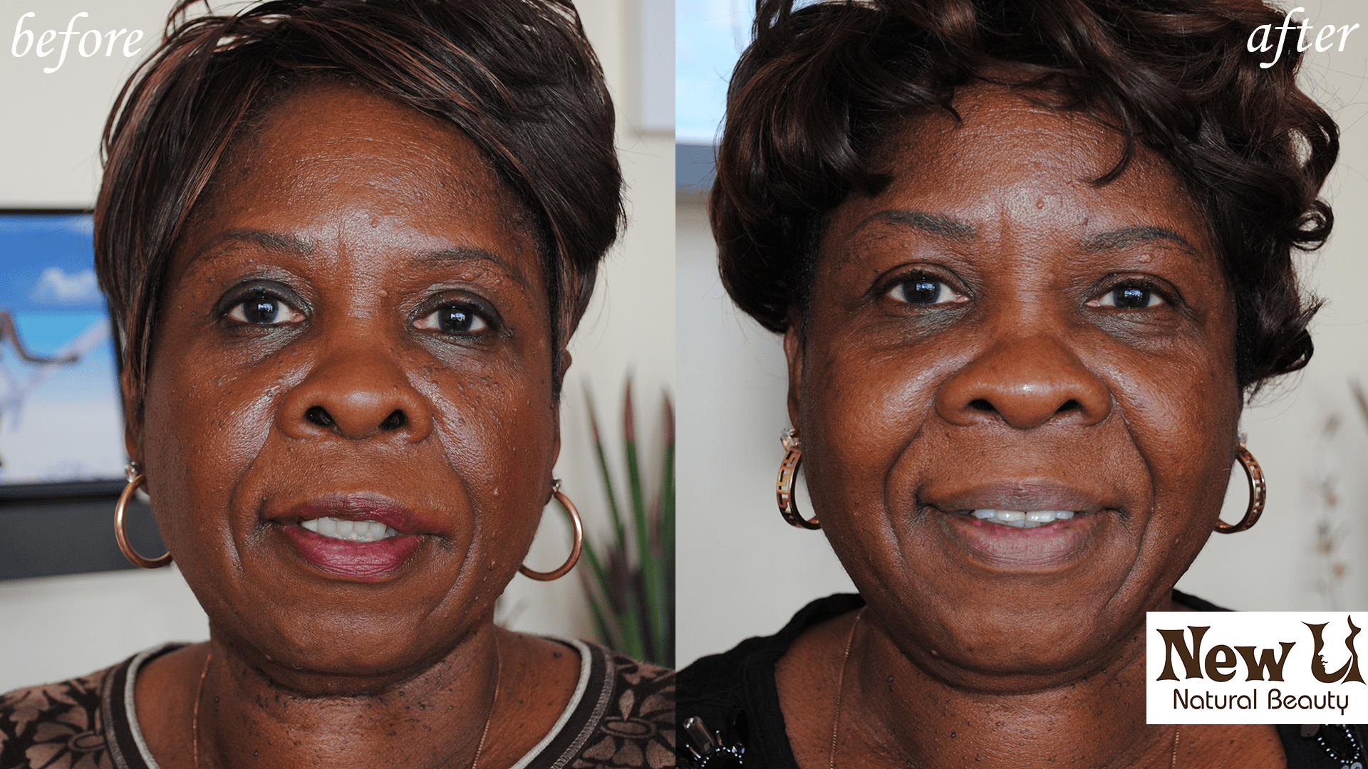 Skin Pigmentation 4 Las Vegas Before & After