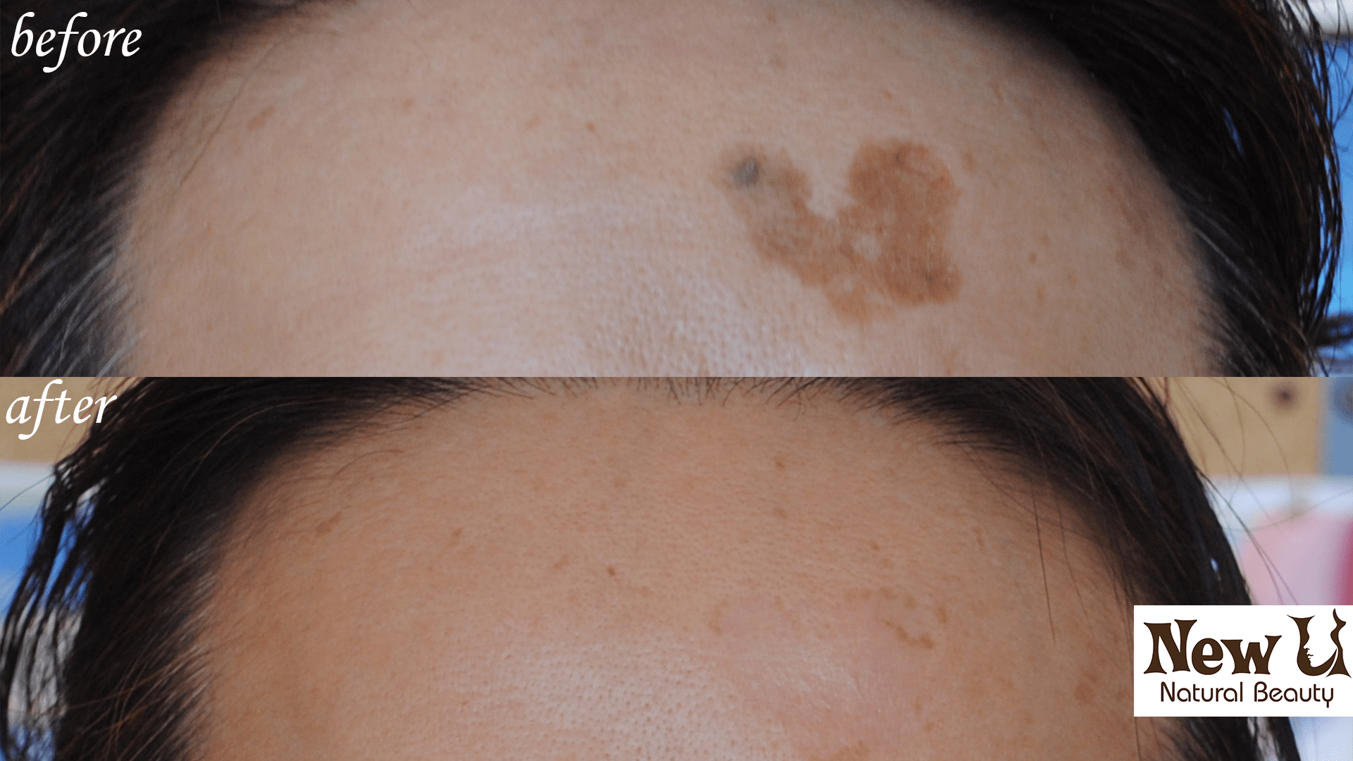 Skin Pigmentation 5 Las Vegas Before & After
