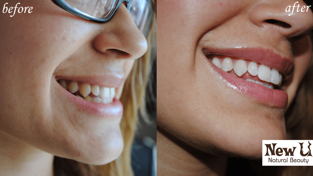 Opt for New U's Teeth Whitening Services Prevent Teeth Staining New