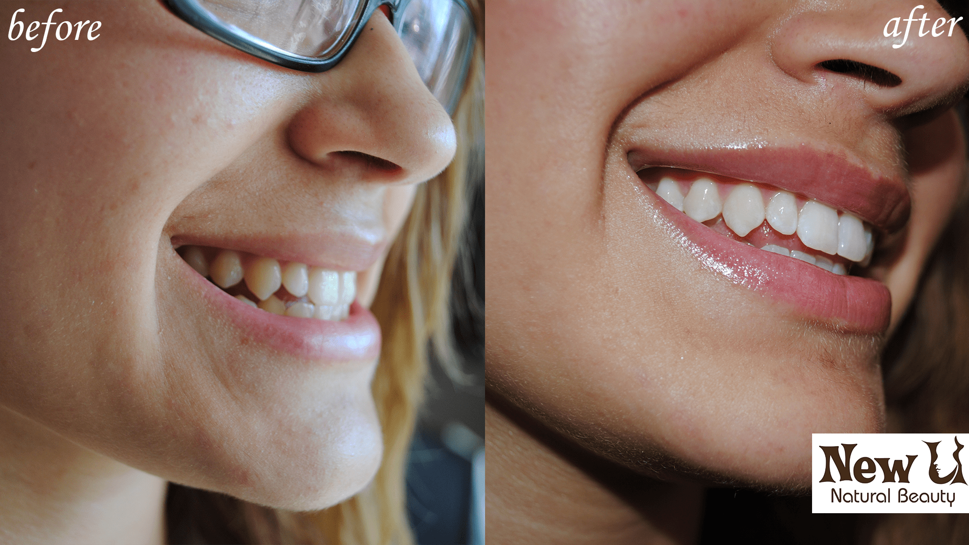 Teeth Whitening Las Vegas Before and After