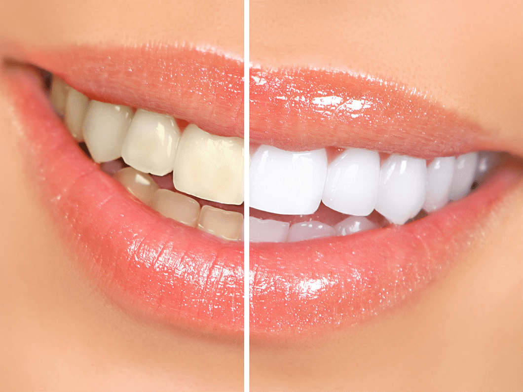 Teeth Whitening Natural Remedies Las Vegas