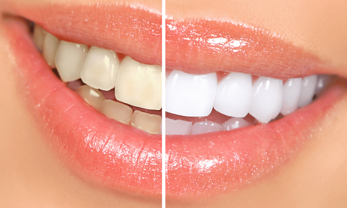 Teeth Whitening Natural Remedies Las Vegas