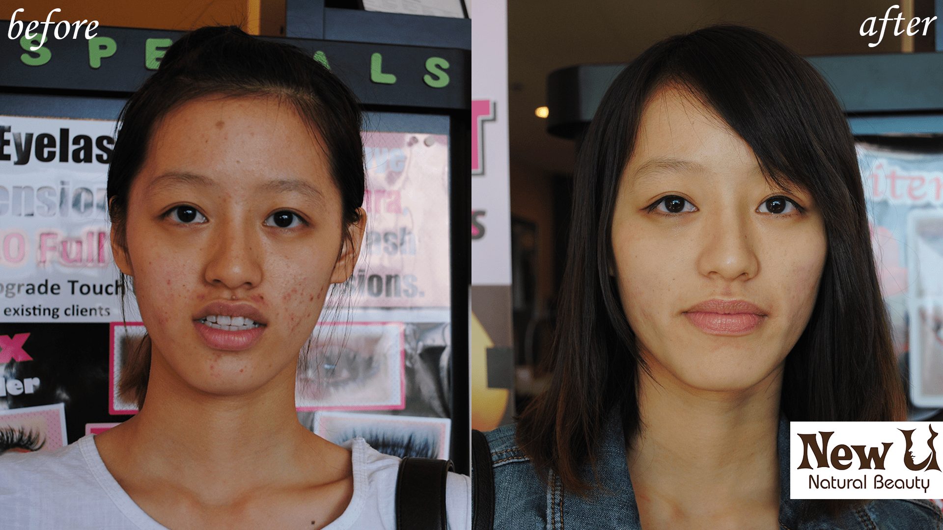 Acne Treatment 1 Las Vegas Before and After