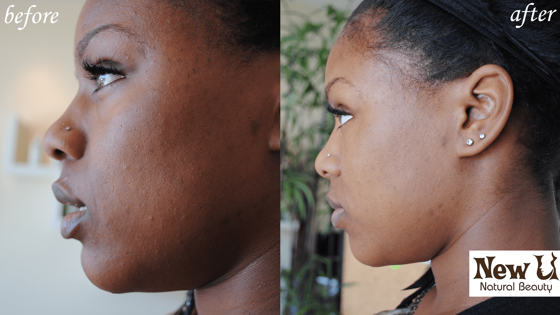 Acne Treatment 2 Las Vegas Before and After