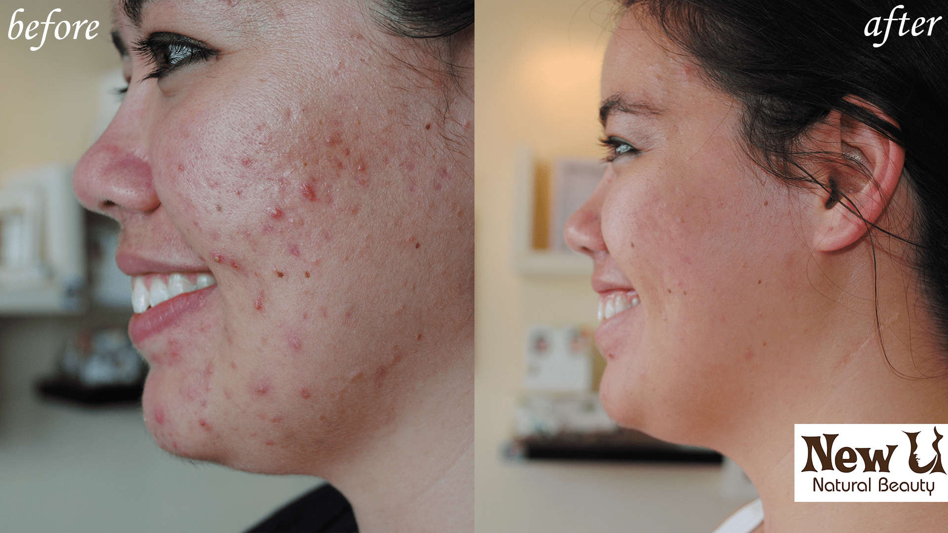Acne Treatment 3 Las Vegas Before and After
