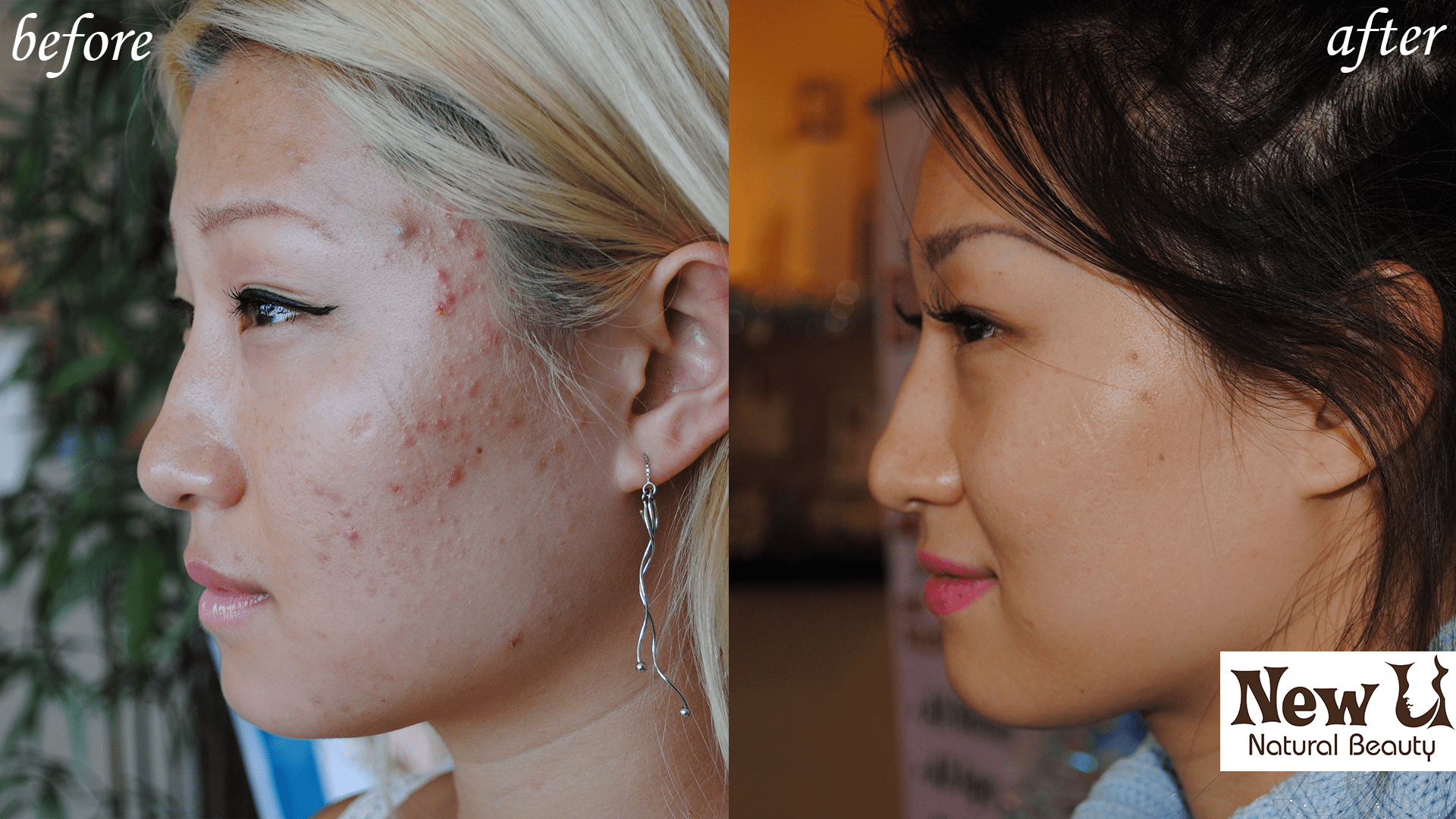 Acne Treatment 4 Las Vegas Before and After
