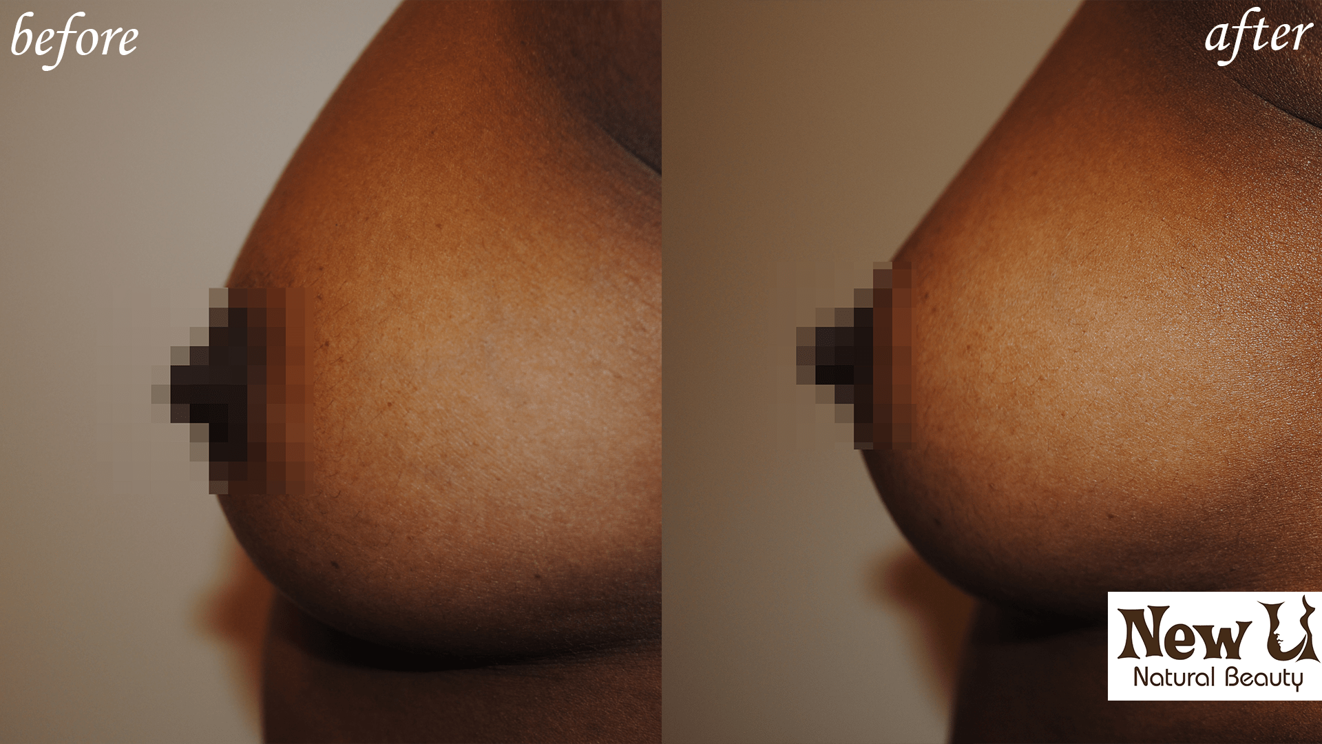 Breast Enhancement 1 Las Vegas Before and After
