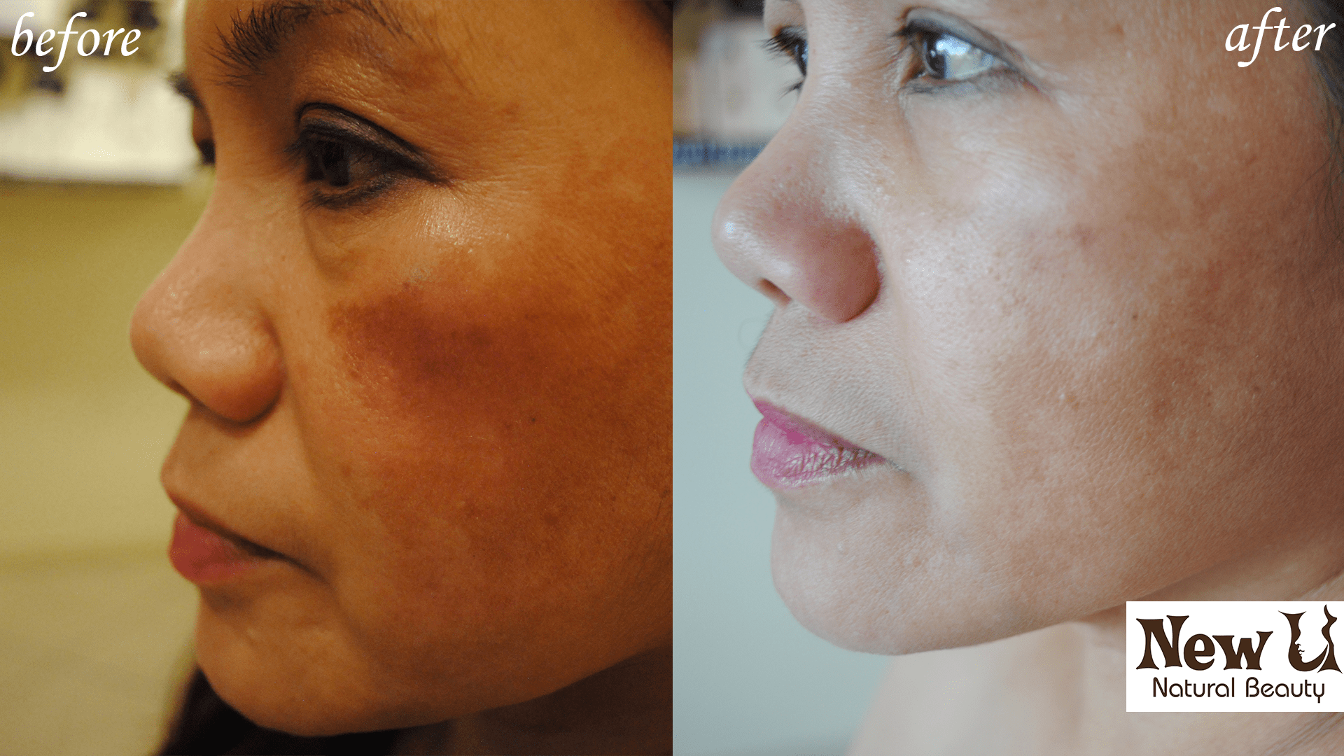 Organic Skin Care 2 Las Vegas Before and After
