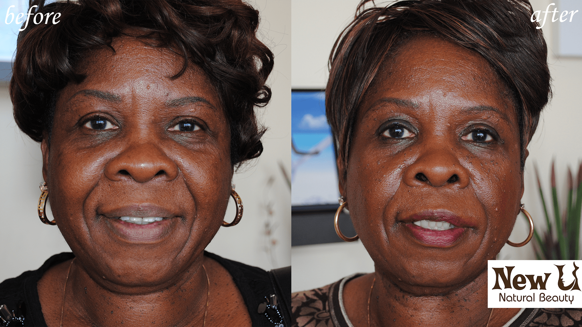 Skin Pigmentation 1 Las Vegas Before and After