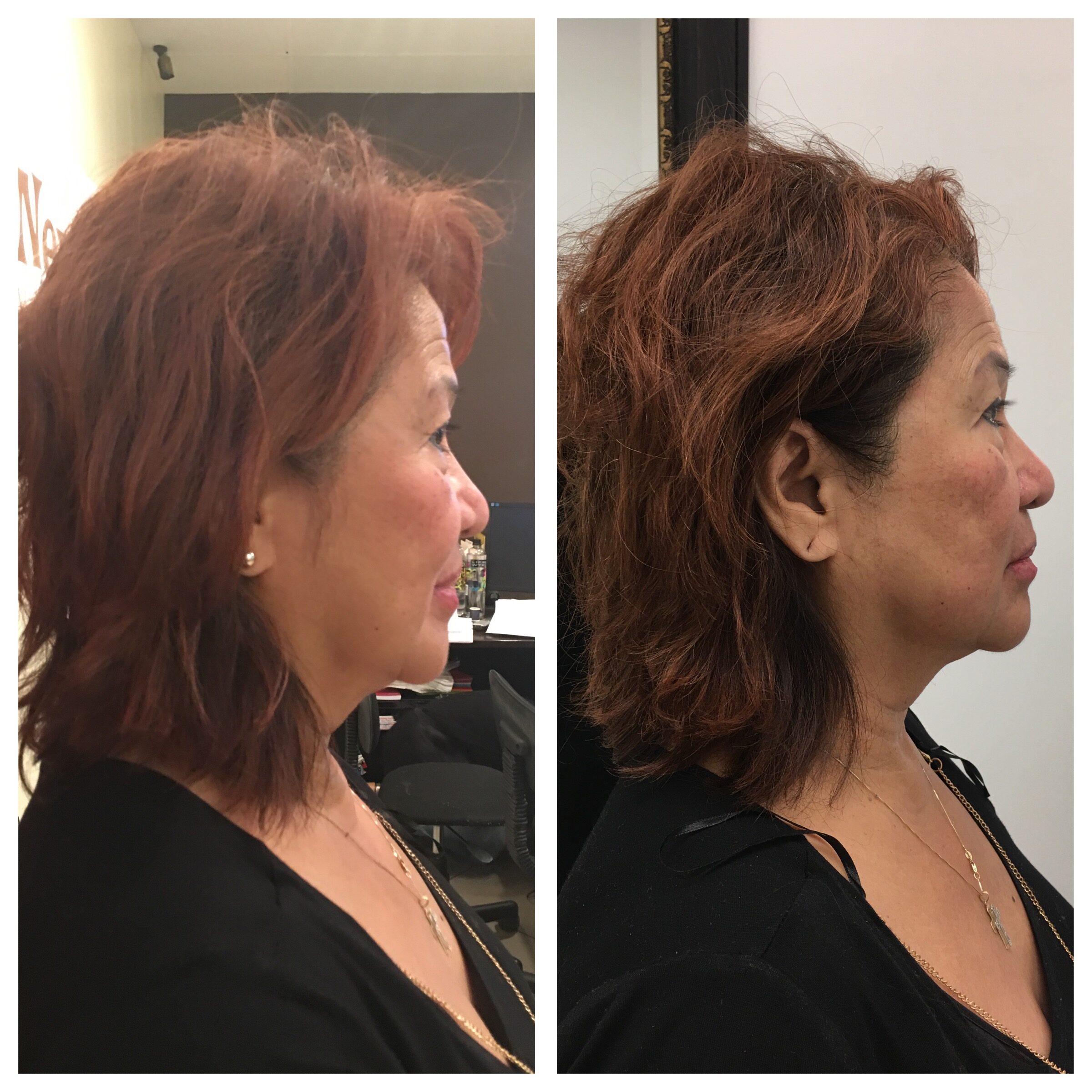 Las Vegas Ultherapy NV Cost