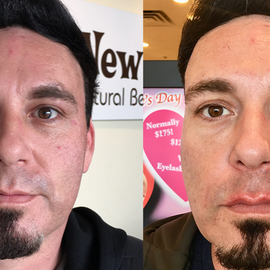 Ultherapy for Men Las Vegas