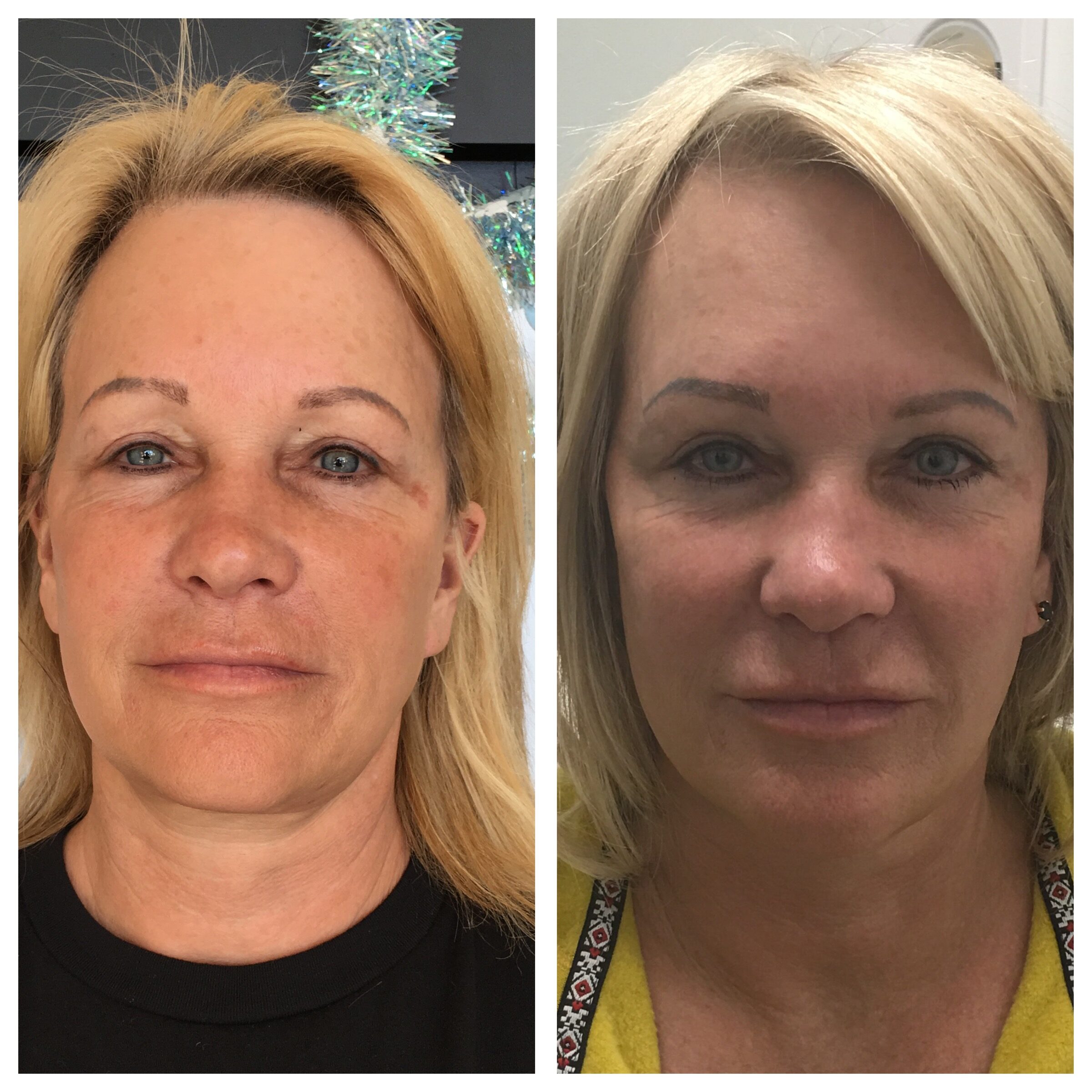 Ultherapy Groupon Las Vegas Henderson