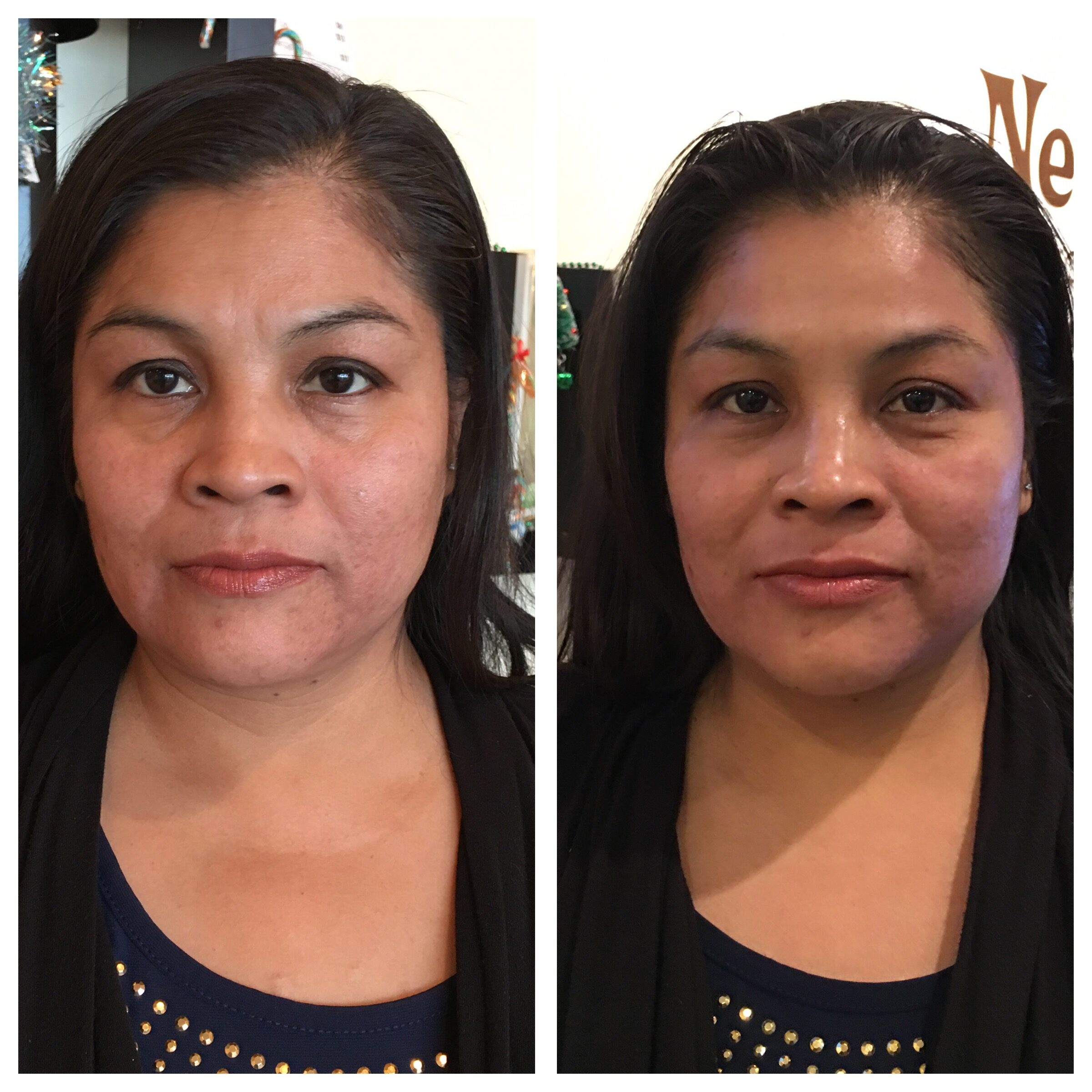 Ultherapy Groupon Las Vegas NV