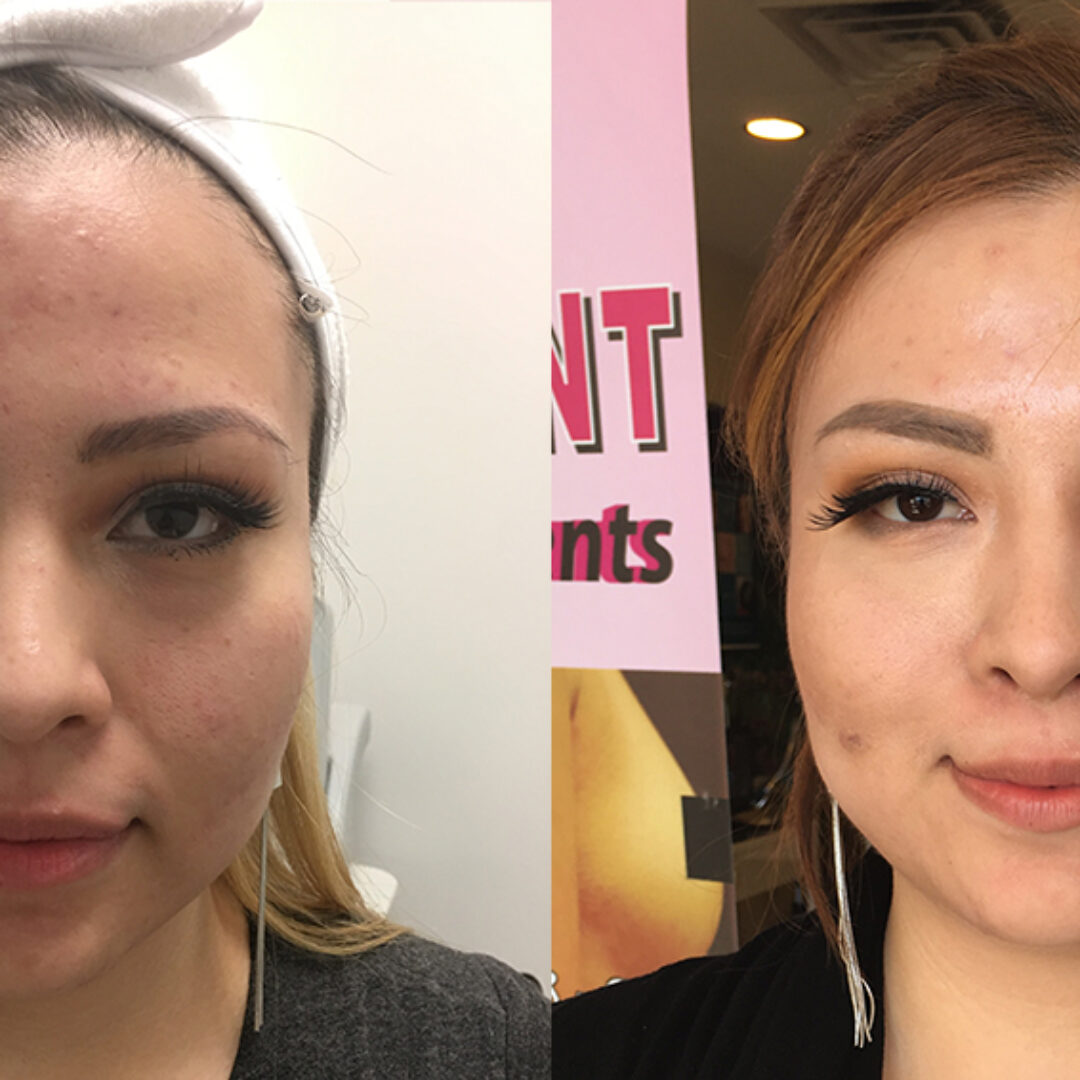 Ultherapy Las Vegas NV