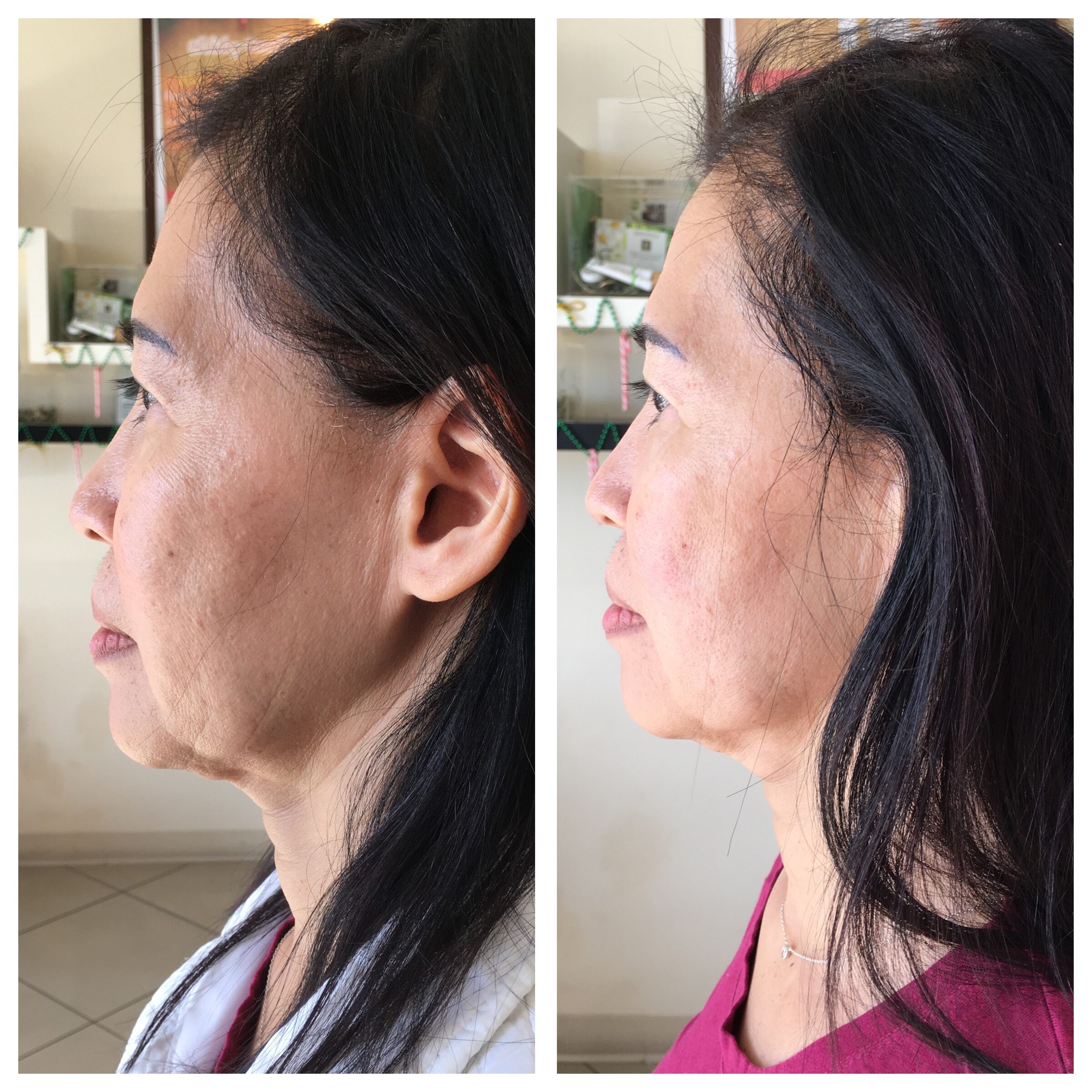 Ultherapy Specials Las Vegas NV